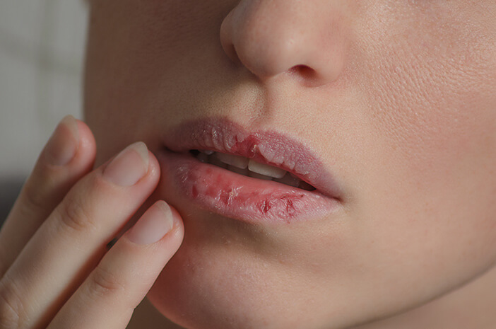 Bibir Kering Saat Puasa